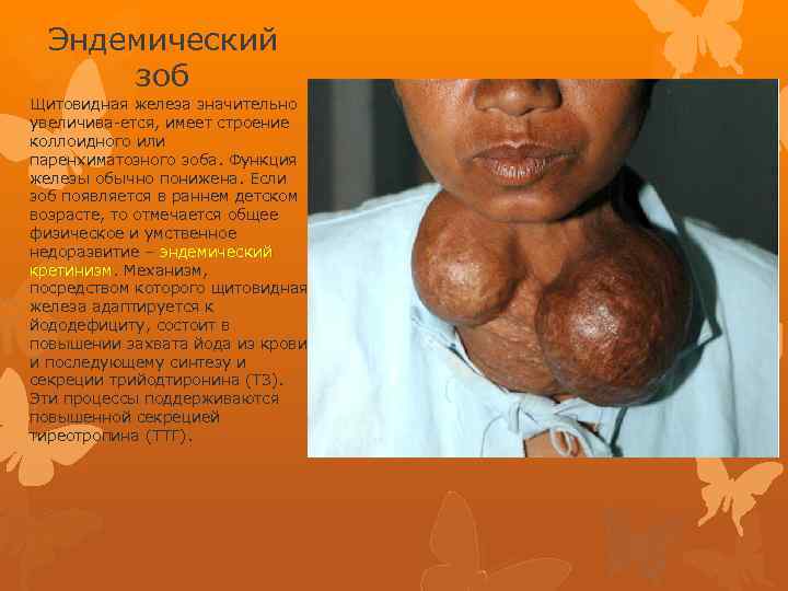 Эндемический зоб Щитовидная железа значительно увеличива-ется, имеет строение коллоидного или паренхиматозного зоба. Функция железы
