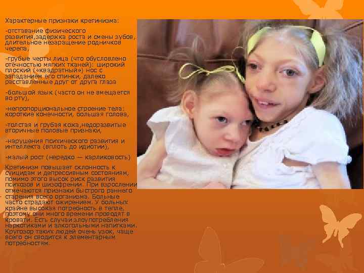 Характерные признаки кретинизма: -отставание физического развития, задержка роста и смены зубов, длительное незаращение родничков