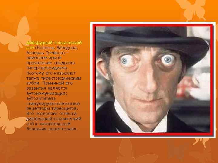 Диффузный токсический зоб (болезнь Базедова, болезнь Грейвса) – наиболее яркое проявление синдрома гипертиреоидизма, поэтому