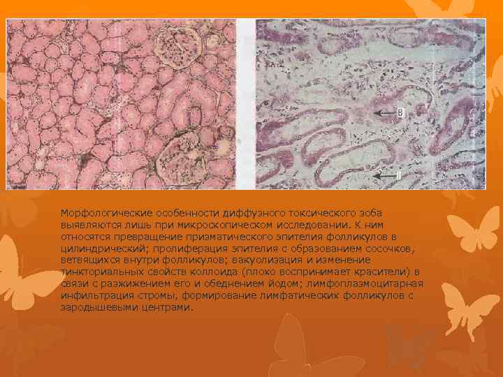 Морфологические особенности диффузного токсического зоба выявляются лишь при микроскопическом исследовании. К ним относятся превращение