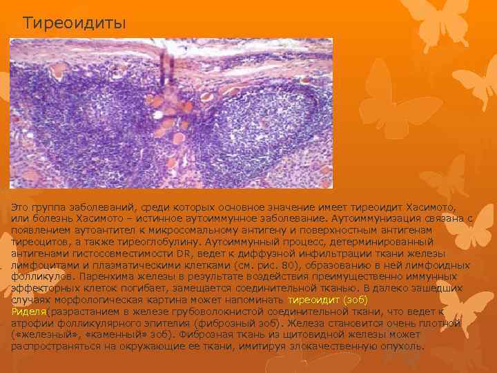 Тиреоидиты Это группа заболеваний, среди которых основное значение имеет тиреоидит Хасимото, или болезнь Хасимото