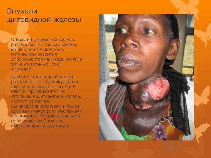 Опухоли щитовидной железы разнообразны, так каждая из ее клеток может быть источником развития доброкачественных