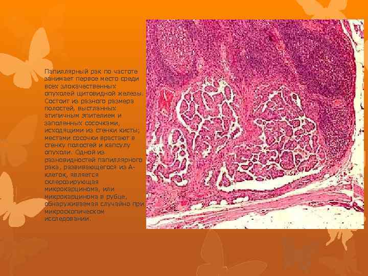 Папиллярный рак по частоте занимает первое место среди всех злокачественных опухолей щитовидной железы. Состоит