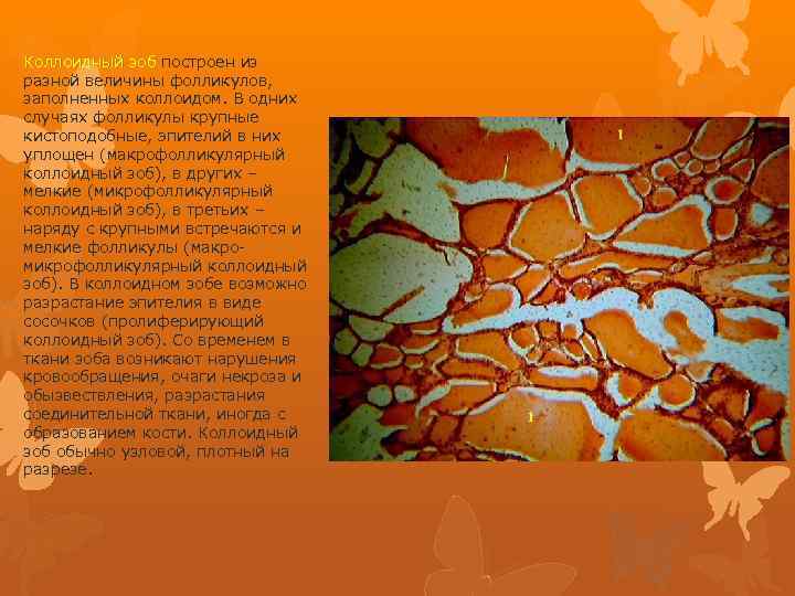 Коллоидный зоб построен из разной величины фолликулов, заполненных коллоидом. В одних случаях фолликулы крупные