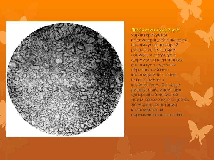 Паренхиматозный зоб характеризуется пролиферацией эпителия фолликулов, который разрастается в виде солидных структур с формированием