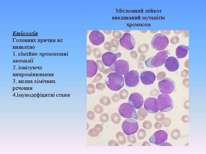Мієломний лейкоз викликаний мутацією хромосом Етіологія Головних причин не виявлено 1. сімейно-хромосомні аномалії 2.