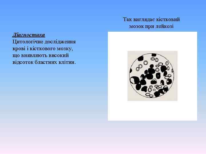 Так виглядає кістковий мозок при лейкозі Діагностика Цитологічне дослідження крові і кісткового мозку, що