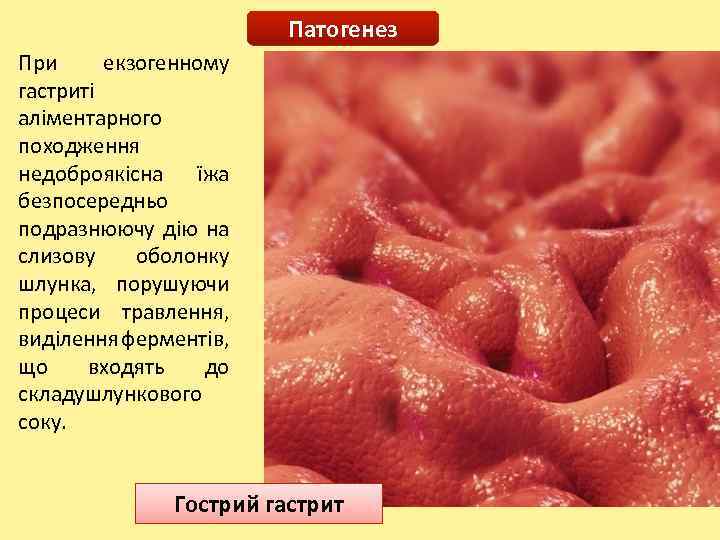 Патогенез При екзогенному гастриті аліментарного походження недоброякісна їжа безпосередньо подразнюючу дію на слизову оболонку