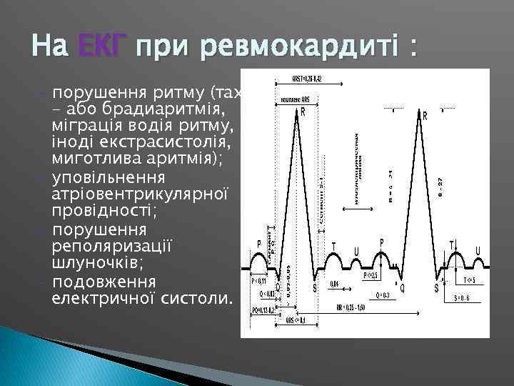 На ЕКГ при ревмокардиті : - порушення ритму (тахі - або брадиаритмія, міграція водія