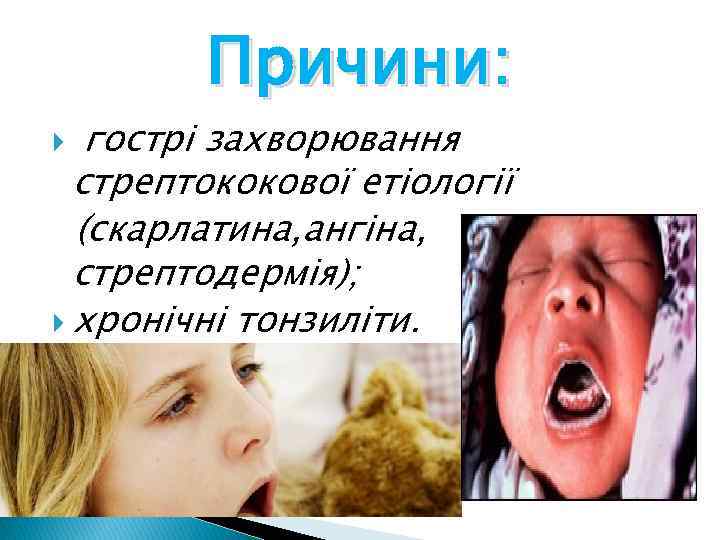 Причини: гострі захворювання стрептококової етіології (скарлатина, ангіна, стрептодермія); хронічні тонзиліти. 