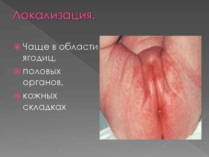 Локализация. Чаще в области ягодиц, половых органов, кожных складках 