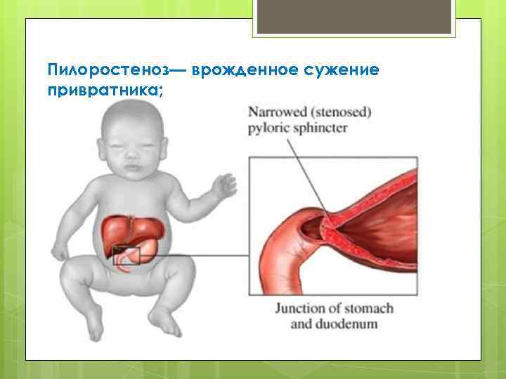 Пилоростеноз врожденный презентация