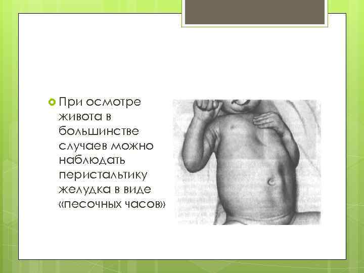  При осмотре живота в большинстве случаев можно наблюдать перистальтику желудка в виде «песочных