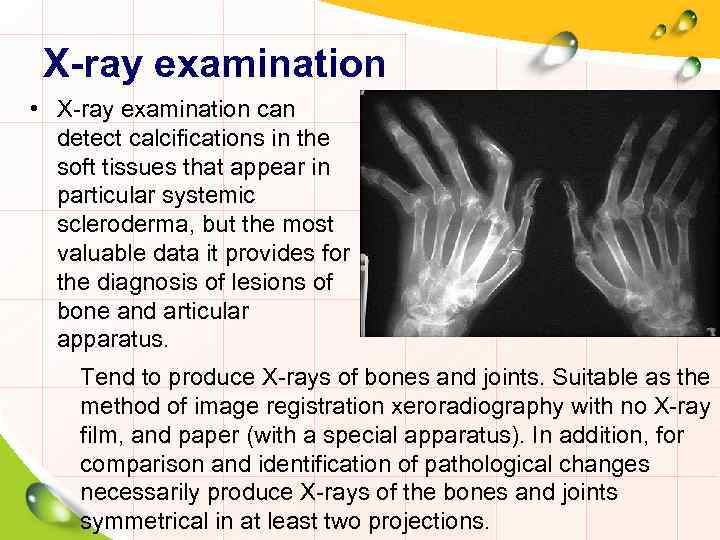 X-ray examination • X-ray examination can detect calcifications in the soft tissues that appear