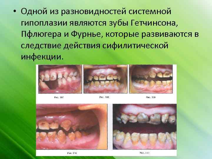  • Одной из разновидностей системной гипоплазии являются зубы Гетчинсона, Пфлюгера и Фурнье, которые