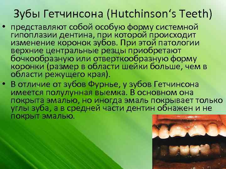 Зубы Гетчинсона (Hutchinson‘s Teeth) • представляют собой особую форму системной гипоплазии дентина, при которой