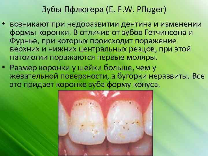 Зубы Пфлюгера (Е. F. W. Pfluger) • возникают при недоразвитии дентина и изменении формы