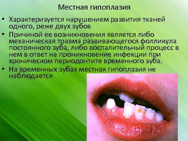 Местная гипоплазия • Характеризуется нарушением развития тканей одного, реже двух зубов • Причиной ее