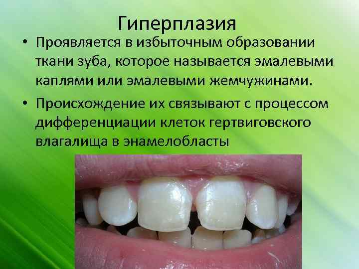 Гиперплазия • Проявляется в избыточным образовании ткани зуба, которое называется эмалевыми каплями или эмалевыми