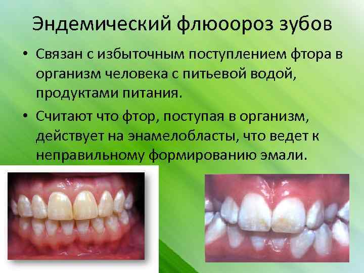 Эндемический флюоороз зубов • Связан с избыточным поступлением фтора в организм человека с питьевой