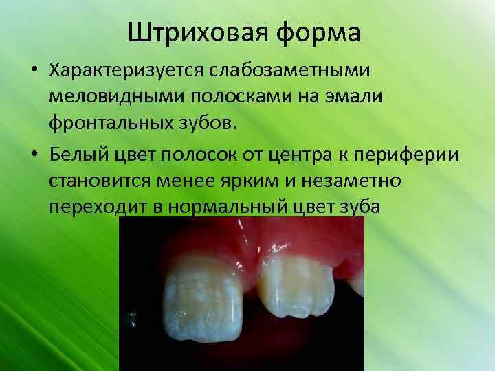 Штриховая форма • Характеризуется слабозаметными меловидными полосками на эмали фронтальных зубов. • Белый цвет