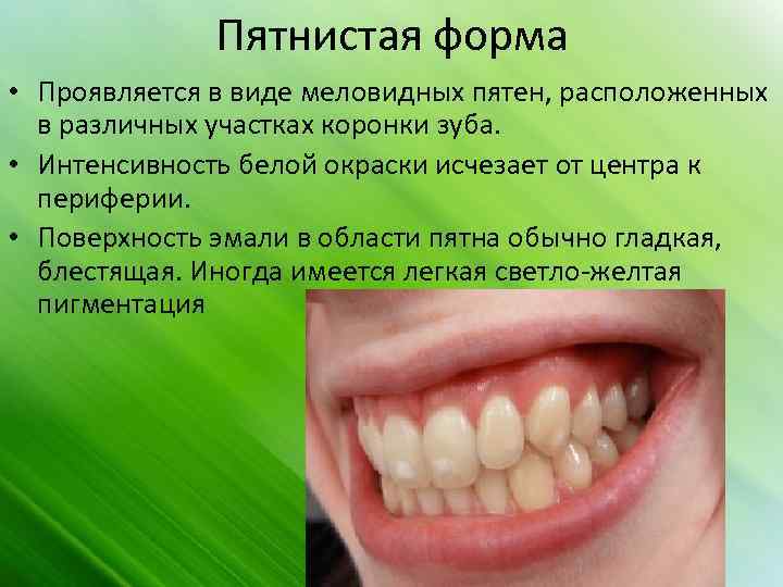 Пятнистая форма • Проявляется в виде меловидных пятен, расположенных в различных участках коронки зуба.