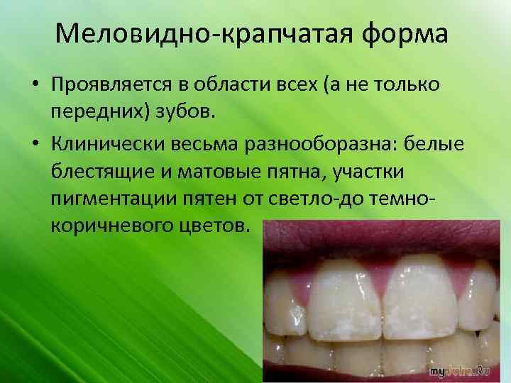 Меловидно-крапчатая форма • Проявляется в области всех (а не только передних) зубов. • Клинически