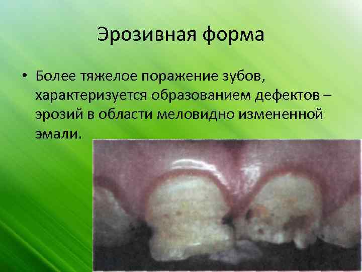 Эрозивная форма • Более тяжелое поражение зубов, характеризуется образованием дефектов – эрозий в области