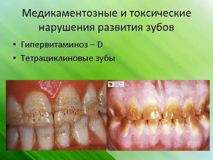 Медикаментозные и токсические нарушения развития зубов • Гипервитаминоз – D • Тетрациклиновые зубы 