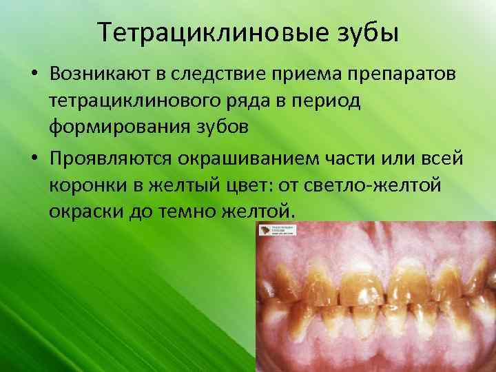 Тетрациклиновые зубы • Возникают в следствие приема препаратов тетрациклинового ряда в период формирования зубов