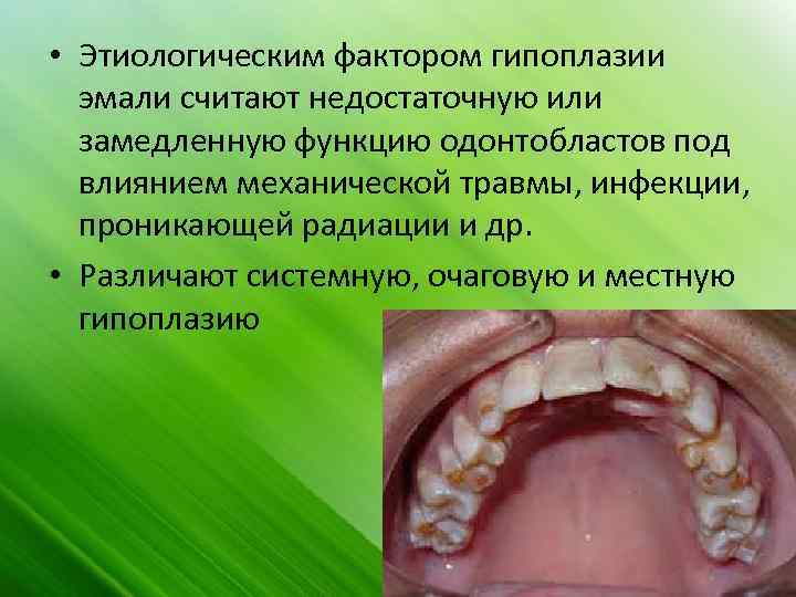  • Этиологическим фактором гипоплазии эмали считают недостаточную или замедленную функцию одонтобластов под влиянием