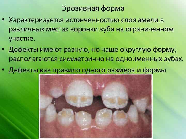 Эрозивная форма • Характеризуется истонченностью слоя эмали в различных местах коронки зуба на ограниченном