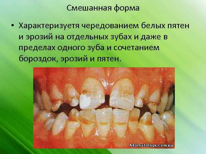 Смешанная форма • Характеризуетя чередованием белых пятен и эрозий на отдельных зубах и даже