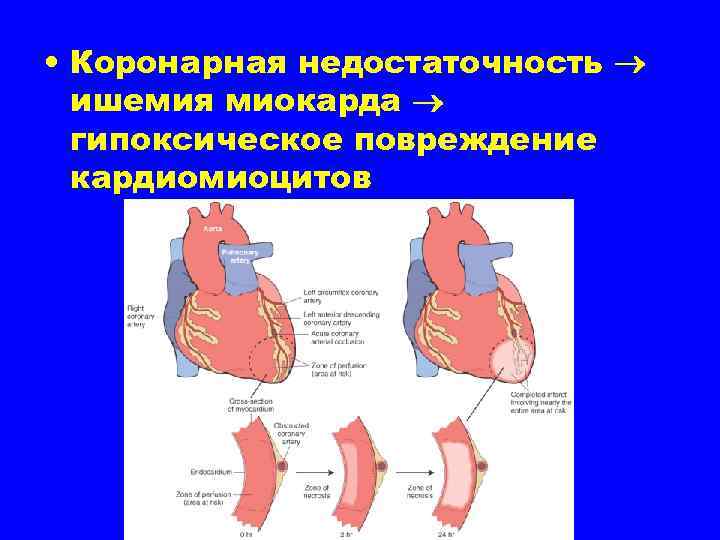  • Коронарная недостаточность ишемия миокарда гипоксическое повреждение кардиомиоцитов 