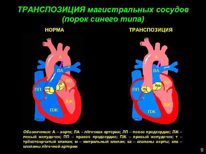 ТРАНСПОЗИЦИЯ магистральных сосудов (порок синего типа) НОРМА ТРАНСПОЗИЦИЯ А А ЛА ЛА ка ПП