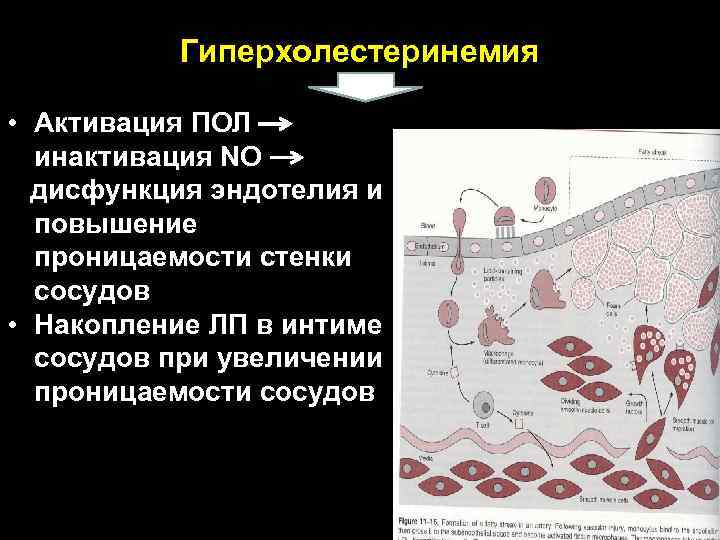 Гиперхолестеринемия • Активация ПОЛ инактивация NO дисфункция эндотелия и повышение проницаемости стенки сосудов •