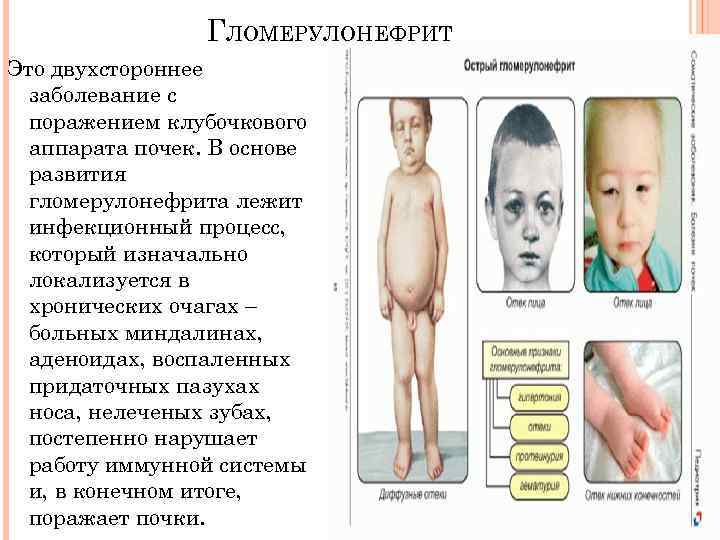 ГЛОМЕРУЛОНЕФРИТ Это двухстороннее заболевание с поражением клубочкового аппарата почек. В основе развития гломерулонефрита лежит