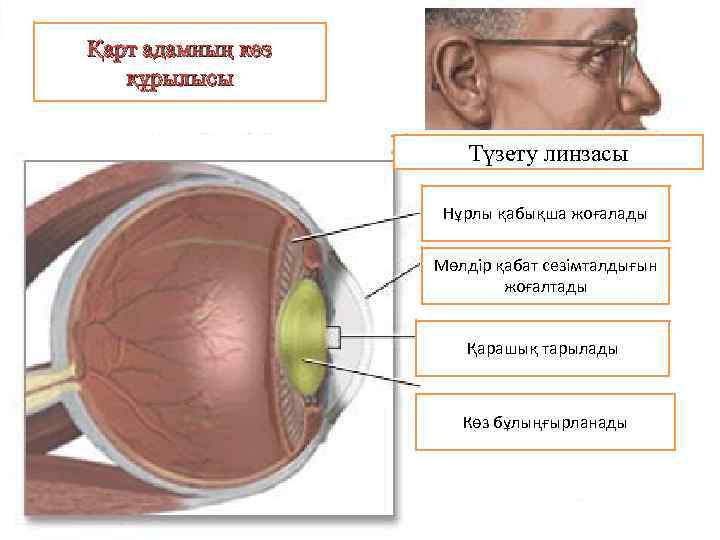 Қарт адамның көз құрылысы Түзету линзасы Нұрлы қабықша жоғалады Мөлдір қабат сезімталдығын жоғалтады Қарашық
