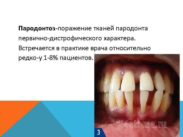 Пародонтоз-поражение тканей пародонта первично-дистрофического характера. Встречается в практике врача относительно редко-у 1 -8% пациентов.