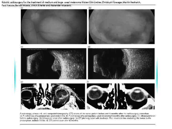 Robotic radiosurgery for the treatment of medium and large uveal melanoma Kirsten Eibl-Lindner, Christoph
