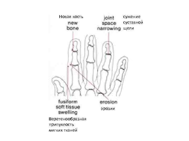 сужение суставной щели Новая кость эрозии Веретенообразная припухлость мягких тканей 