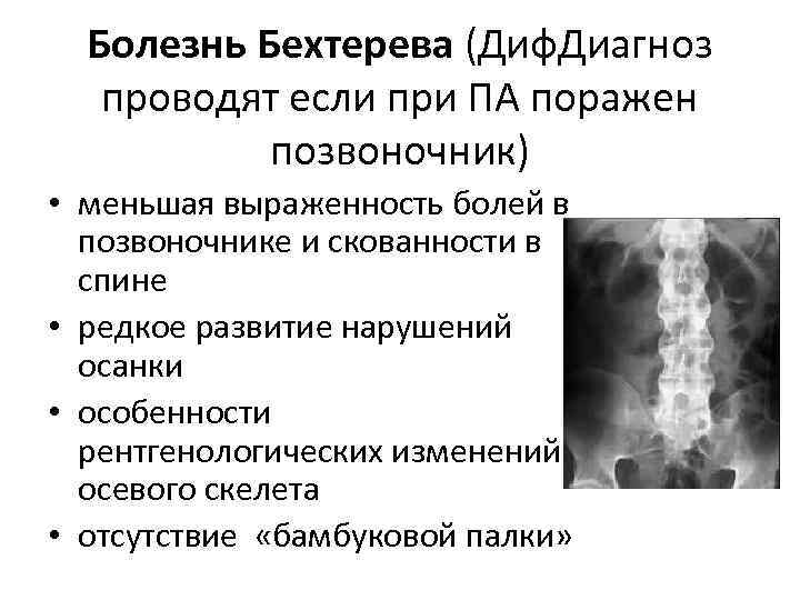 Анкилозирующий спондилез