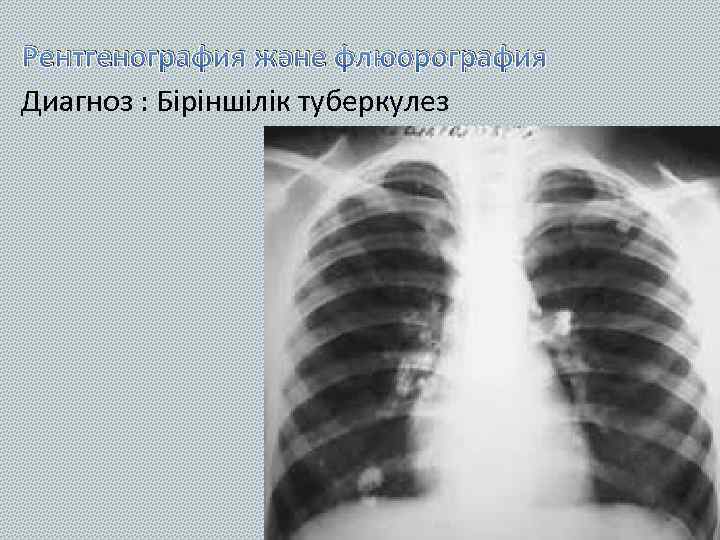 Рентгенография және флюорография Диагноз : Біріншілік туберкулез 