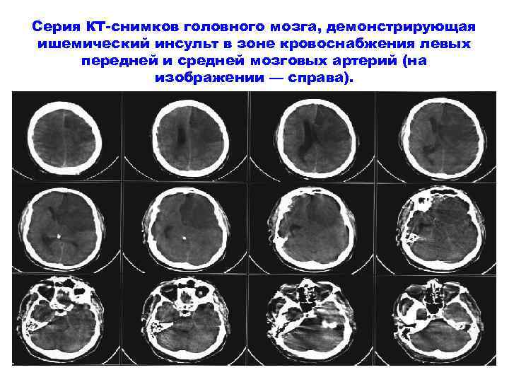 Серия КТ-снимков головного мозга, демонстрирующая ишемический инсульт в зоне кровоснабжения левых передней и средней
