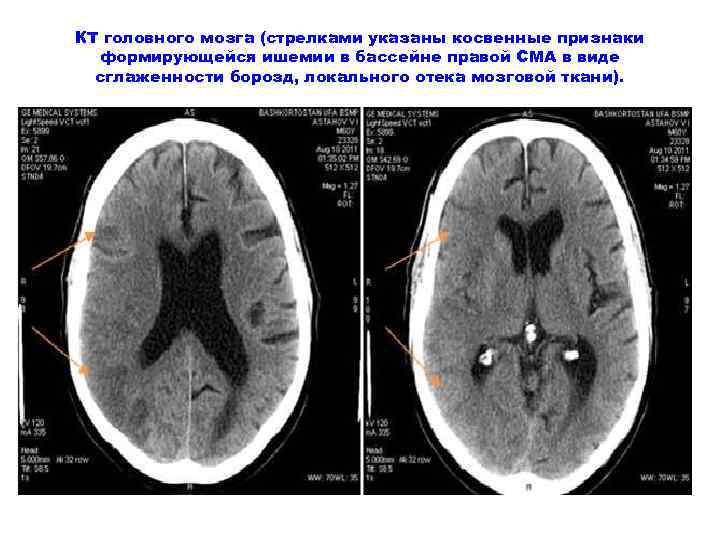 КТ головного мозга (стрелками указаны косвенные признаки формирующейся ишемии в бассейне правой СМА в