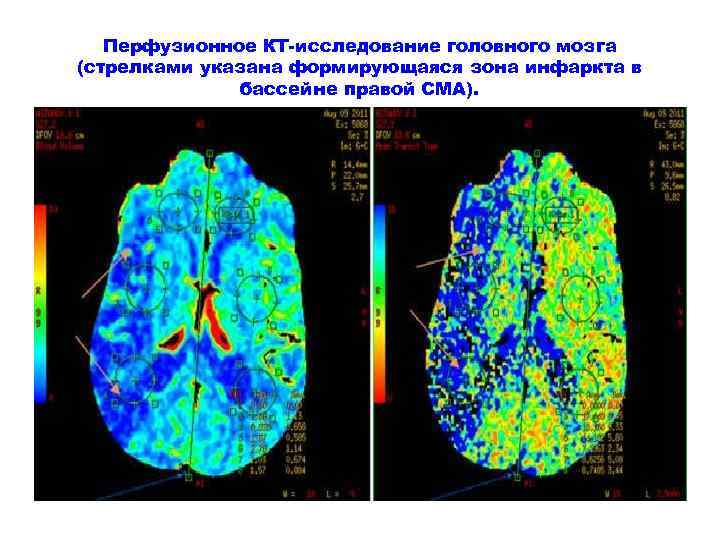 Перфузионное КТ-исследование головного мозга (стрелками указана формирующаяся зона инфаркта в бассейне правой СМА). 