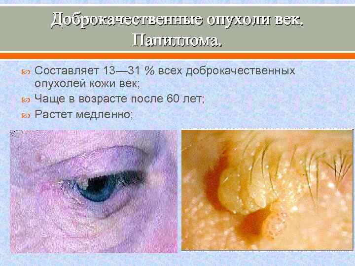 Доброкачественные опухоли век. Папиллома. Составляет 13— 31 % всех доброкачественных опухолей кожи век; Чаще