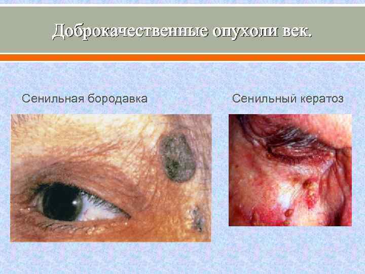 Доброкачественные опухоли век. Сенильная бородавка Сенильный кератоз 