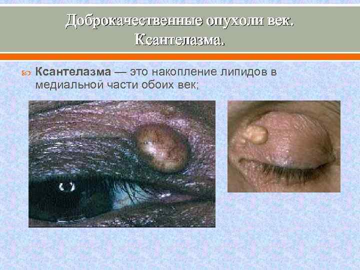 Доброкачественные опухоли век. Ксантелазма — это накопление липидов в медиальной части обоих век; 