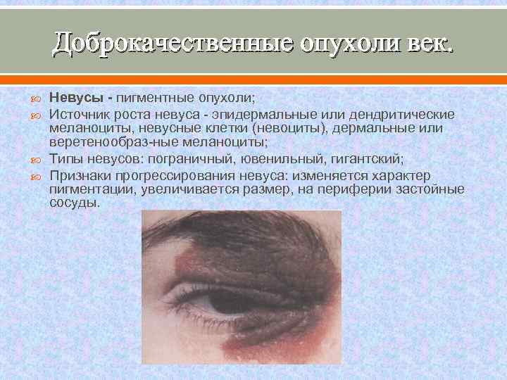 Доброкачественные опухоли век. Невусы - пигментные опухоли; Источник роста невуса эпидермальные или дендритические меланоциты,